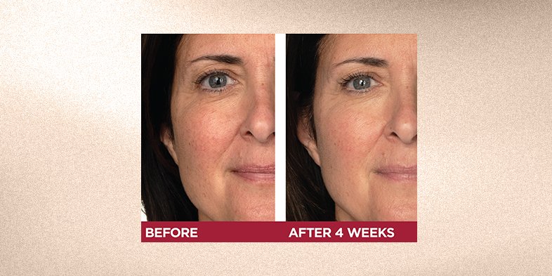 Before and after picture of woman's skin after using retinol